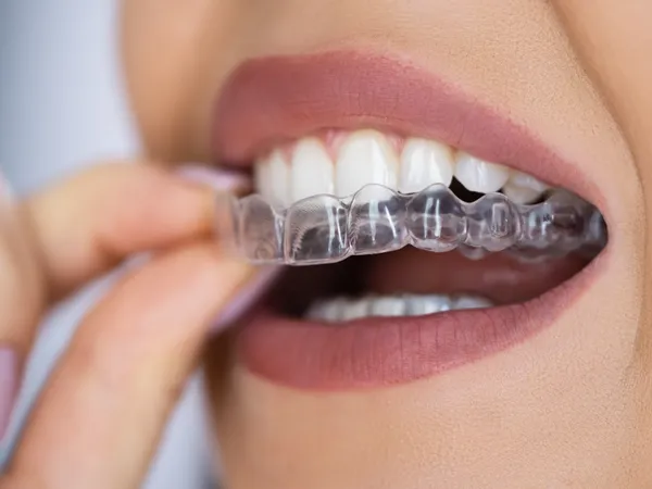 Clear aligner trays shown on a neutral surface