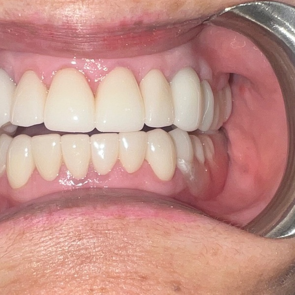 After: Full smile restoration