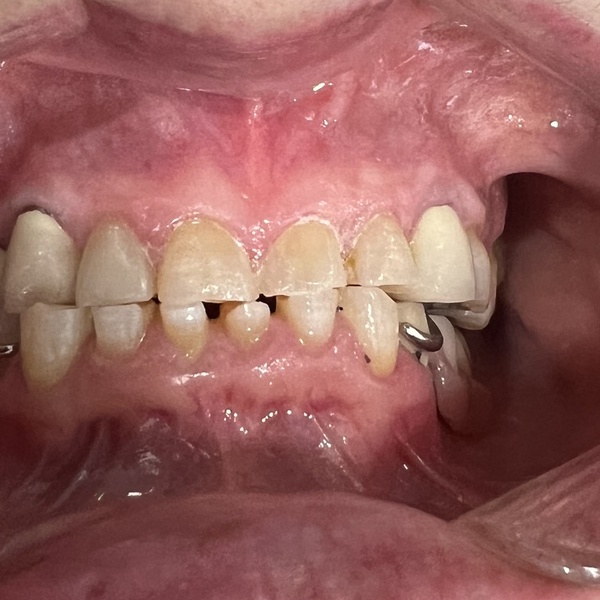 Before: Full smile restoration