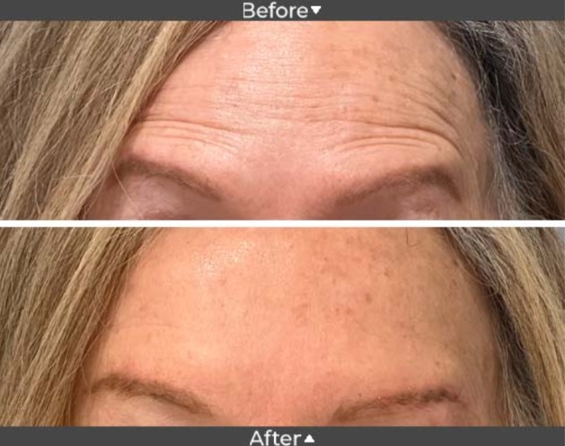Botox Result 1 Botox Result 1