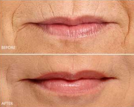 Botox Result 2 Botox Result 2