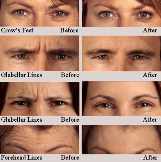 Botox Result 3 Botox Result 3